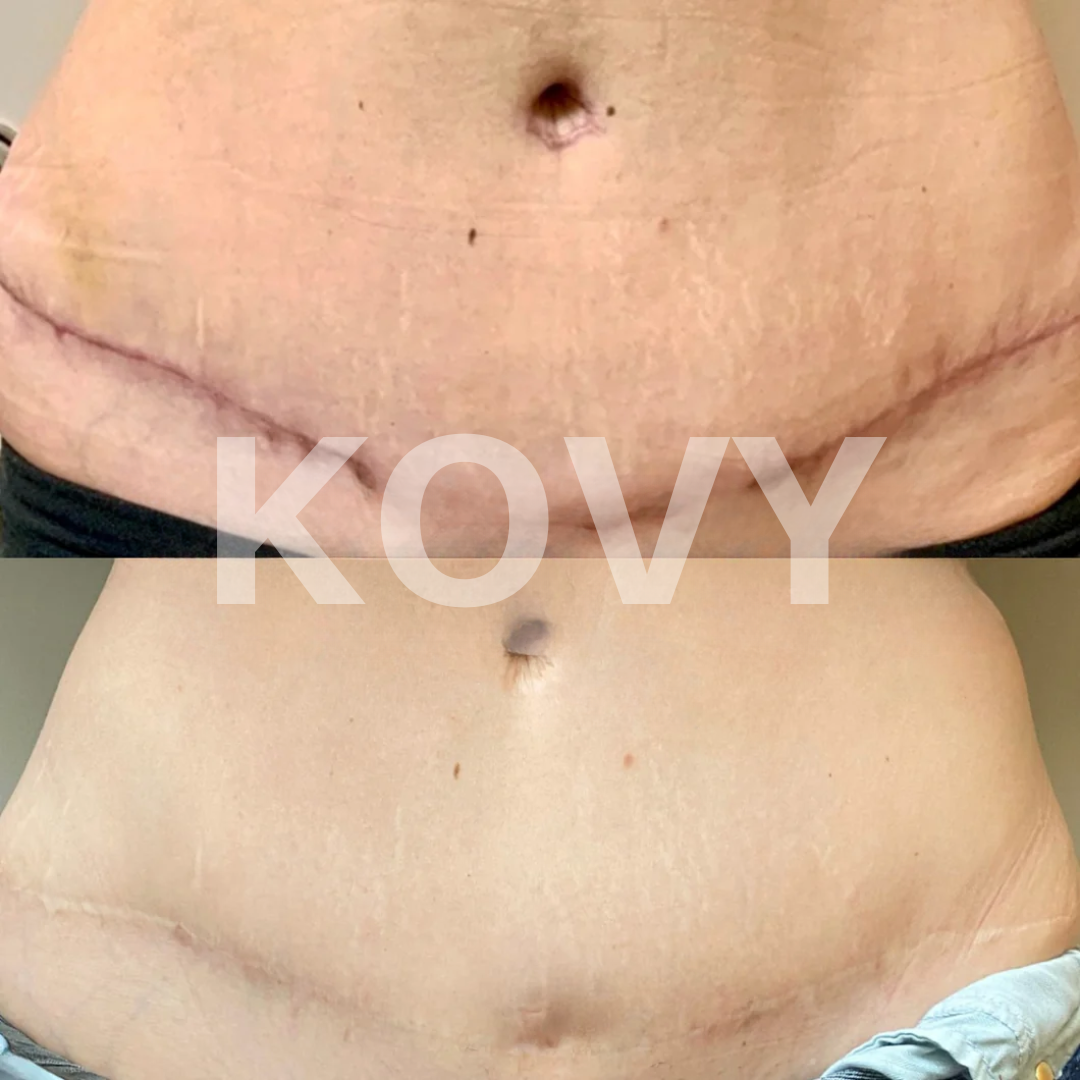 Kovy™ Scar Solutions Silicone Stick