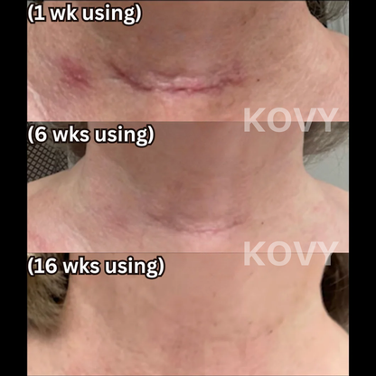 Kovy™ Scar Solutions Silicone Stick