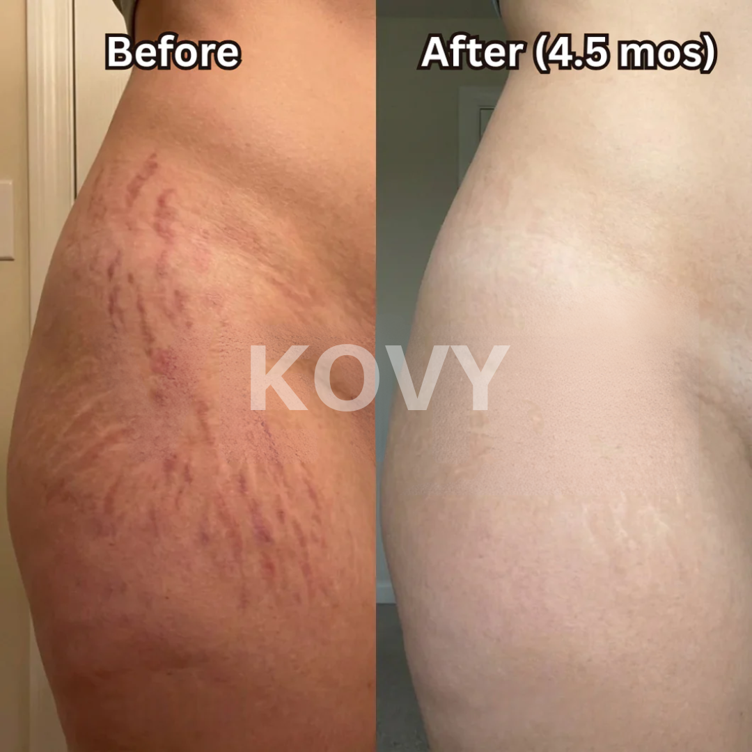 Kovy™ Scar Solutions Silicone Stick