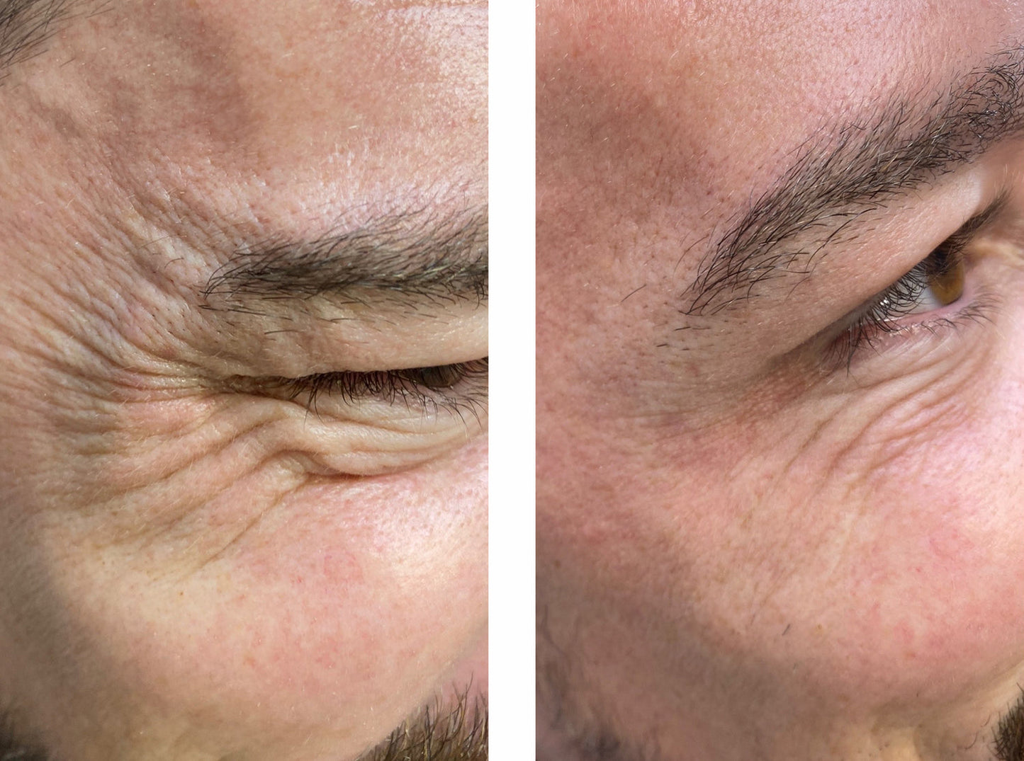 Under-Eye Repair Patches for Men