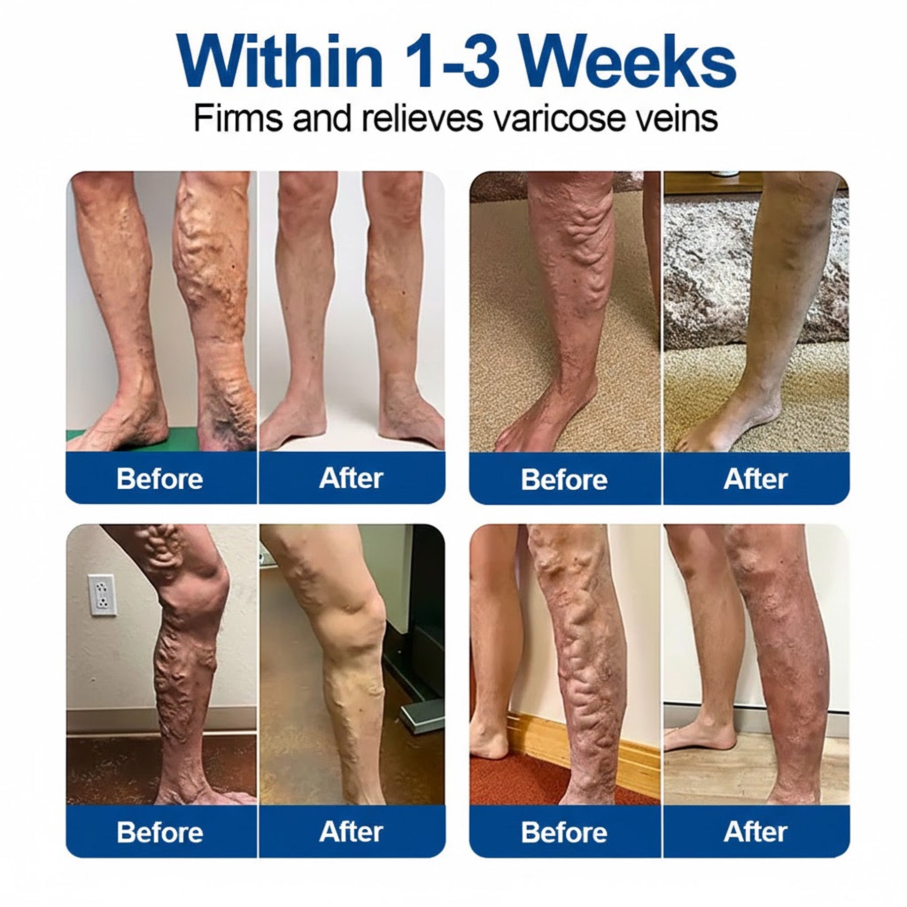 KOVY VeinPatch – Before After Legs