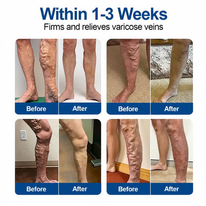 KOVY VeinPatch – Before After Legs